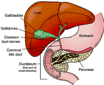 Why Gallstones