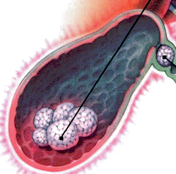 Gallstones diet