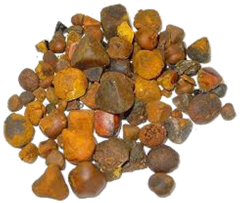 Have Gallstones removed