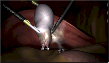Gallstones treatments
